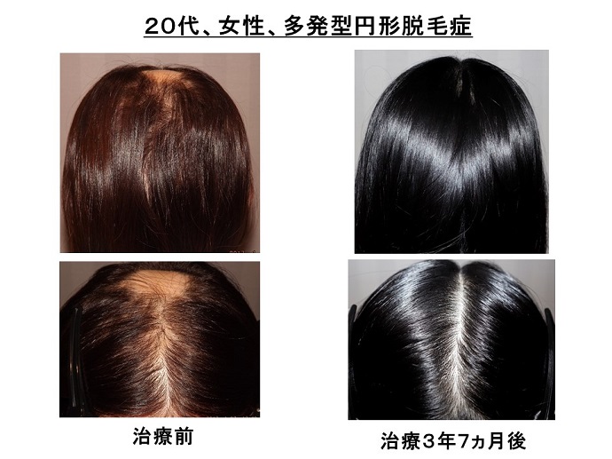 円形脱毛症　病院